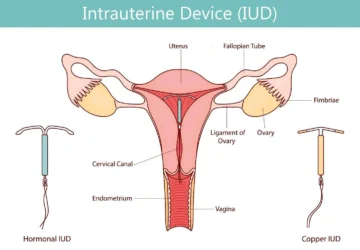 Mengenal Lebih Dekat tentang Pemasangan IUD: Bisa Dilakukan Saat Haid atau Tidak?