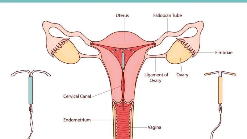 Mengenal Lebih Dekat tentang Pemasangan IUD: Bisa Dilakukan Saat Haid atau Tidak?