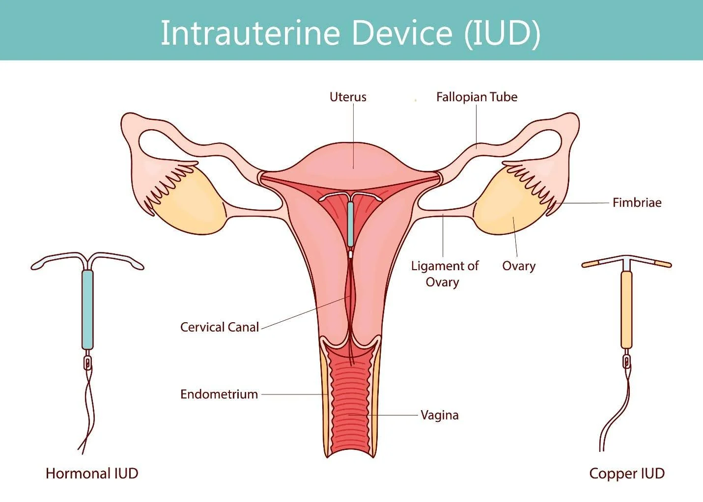 Mengenal Lebih Dekat tentang Pemasangan IUD: Bisa Dilakukan Saat Haid atau Tidak?